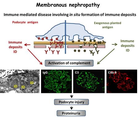 Membranous nephropathy